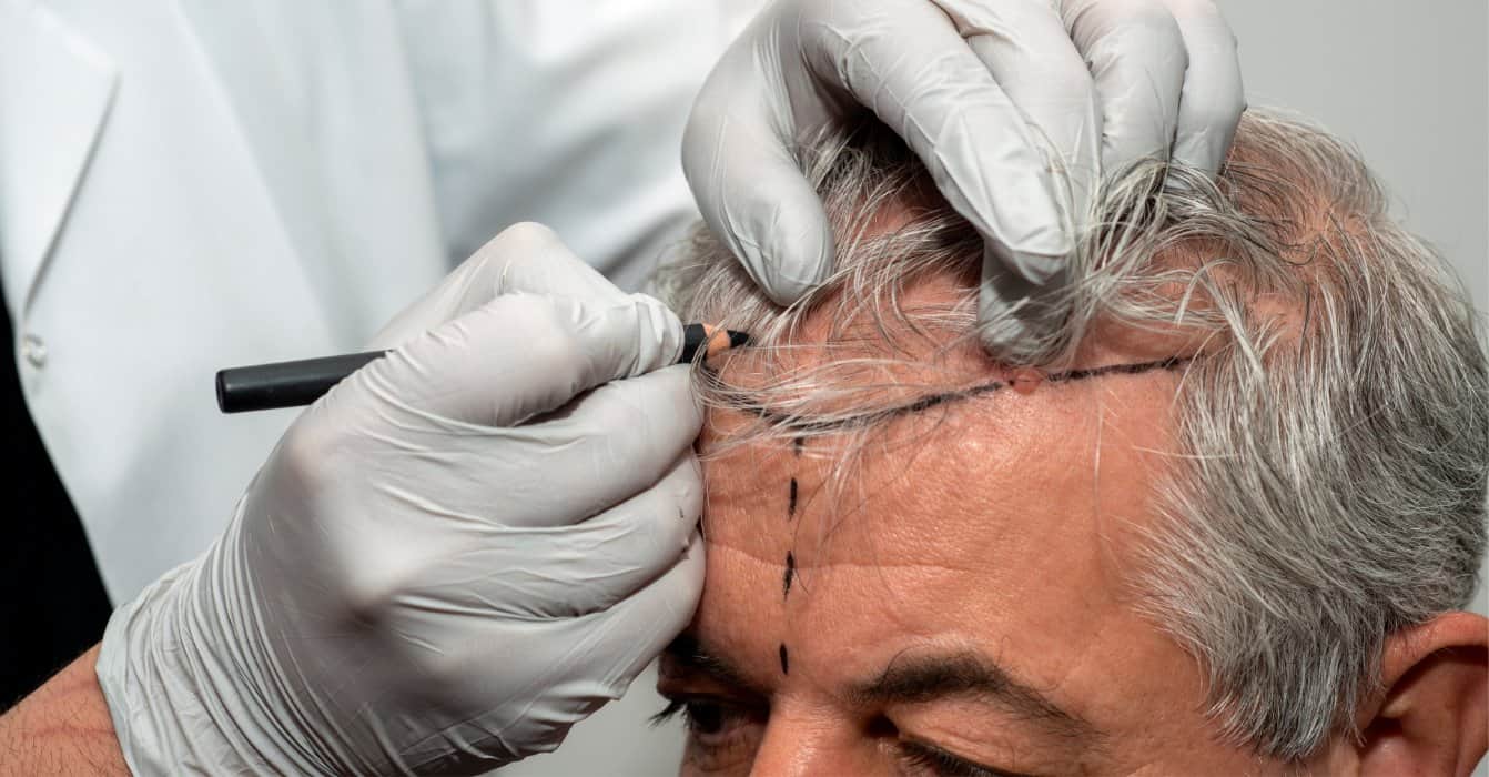 Overvejer du en h&aring;rtransplantation