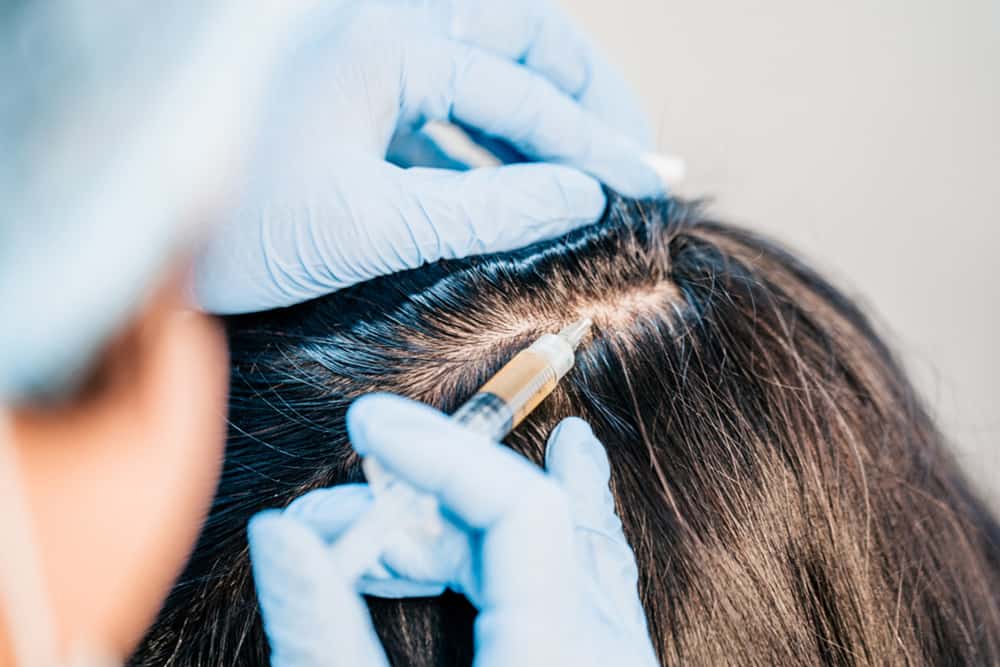 PRP-terapi hjælper på hårtabet